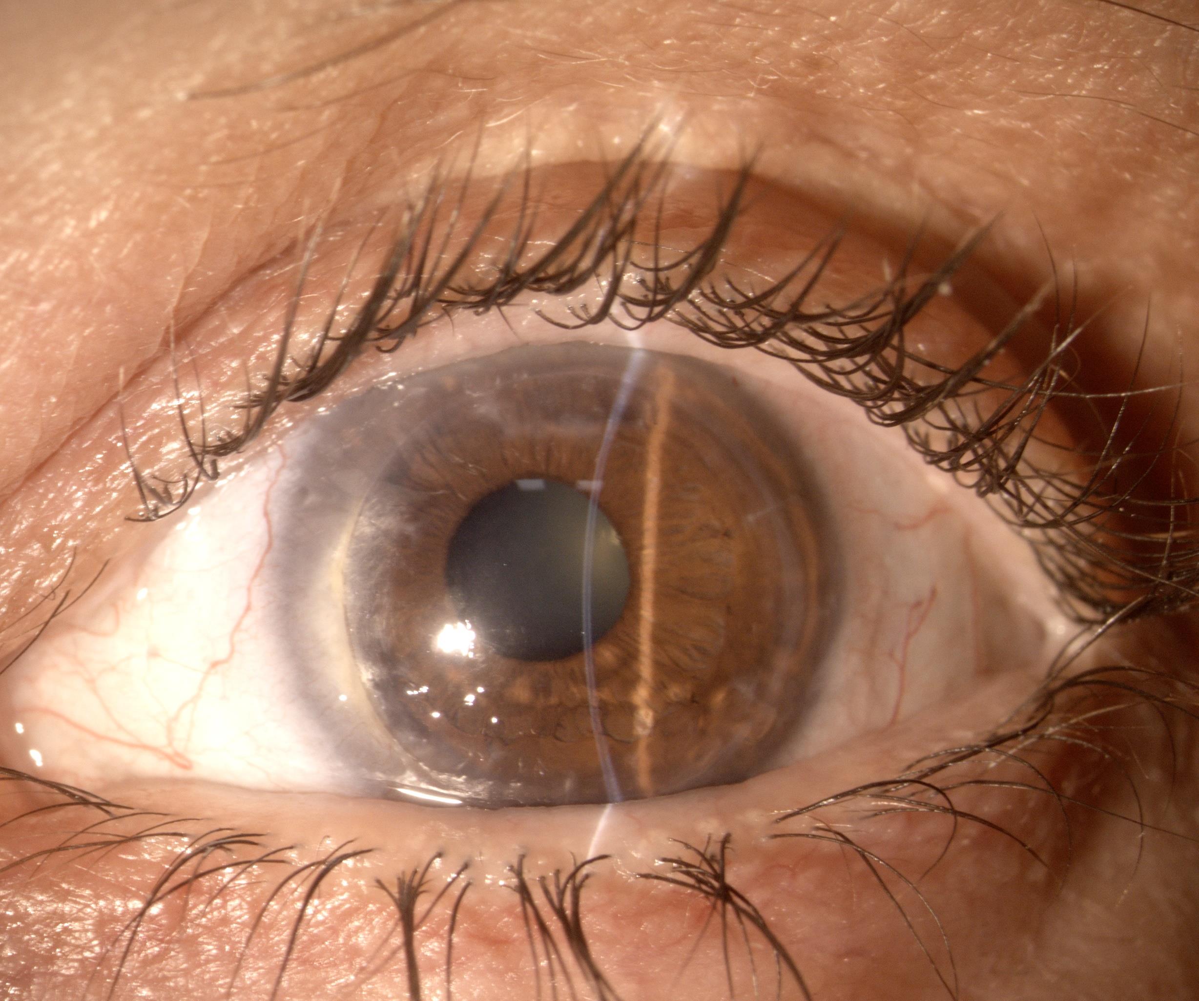 Aspetto cornea dopo l'intervento