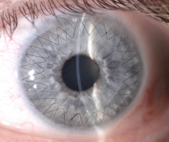 Aspetto cornea dopo l'intervento, ulteriore immagine