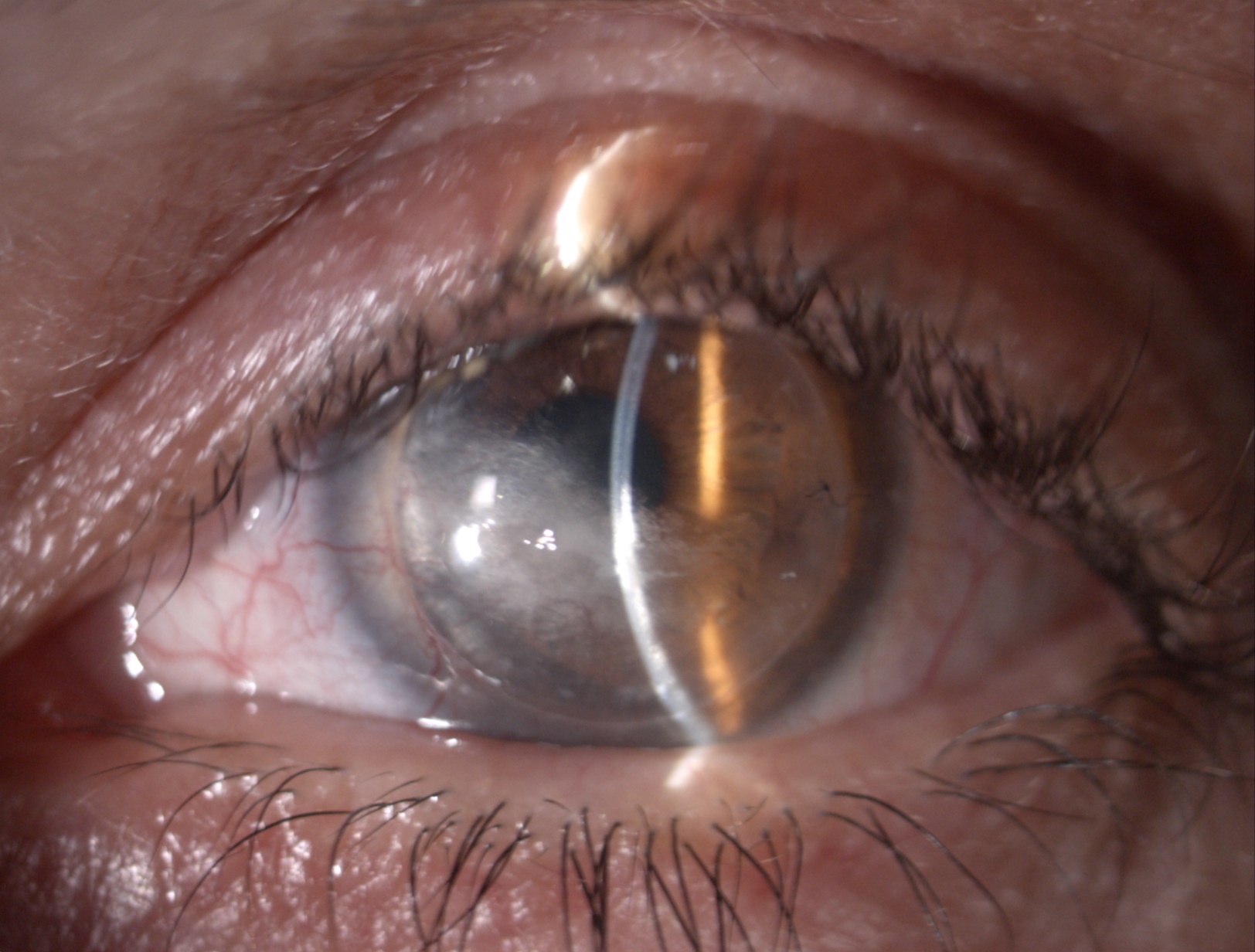 Aspetto cornea prima dell'intervento